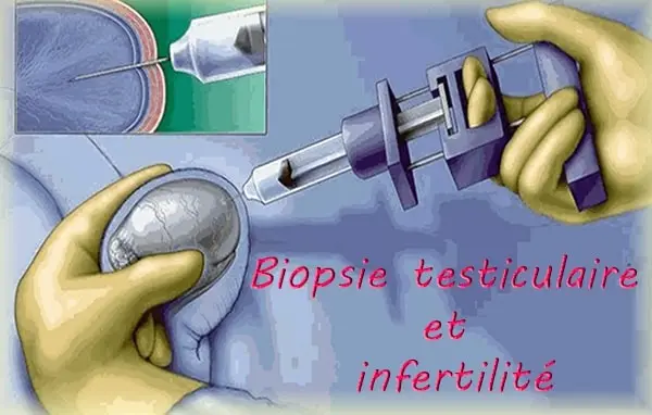 Biopsie testiculaire