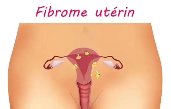 fibrome utérin